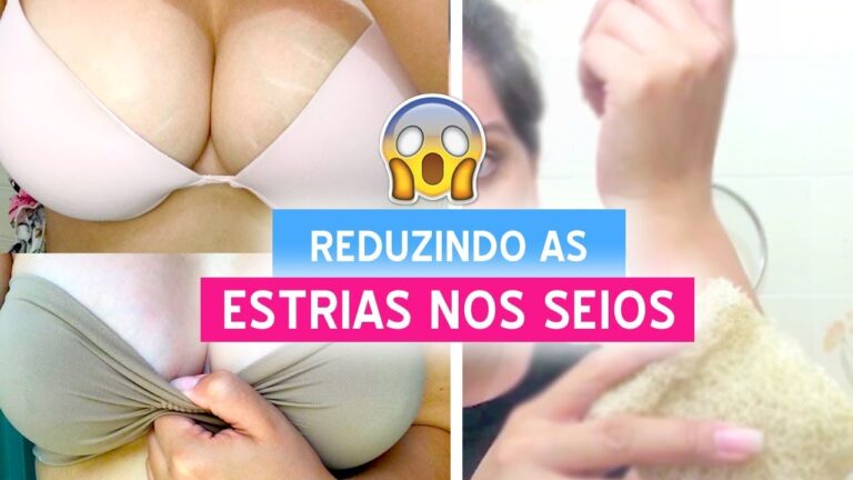 Tratamento Eficaz para Estrias nos Seios