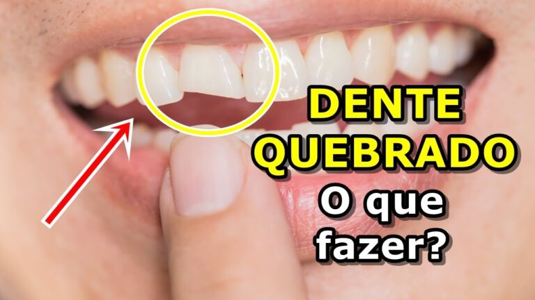 Como Disfar&ccedil;ar um Dente Quebrado