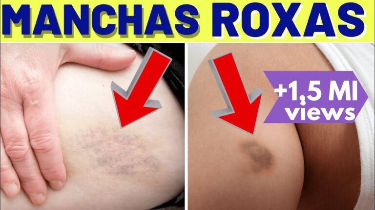 Como Remover Manchas Amarelas no Peito
