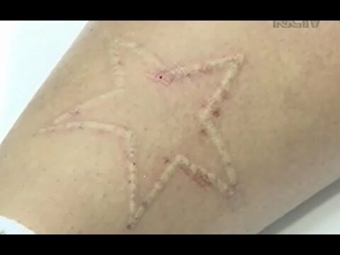 Custo do Remo&ccedil;&atilde;o de Tatuagem a Laser
