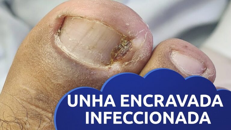 Tratamento eficaz para unha encravada: Fucidine em destaque.