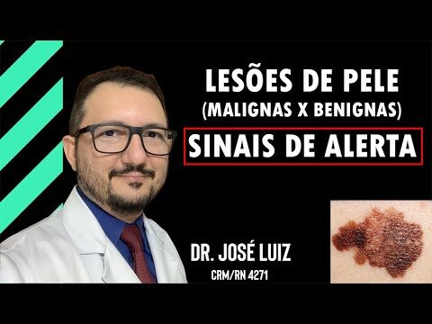 Sinais Benignos na Pele: O Que S&atilde;o e Como Identific&aacute;-los