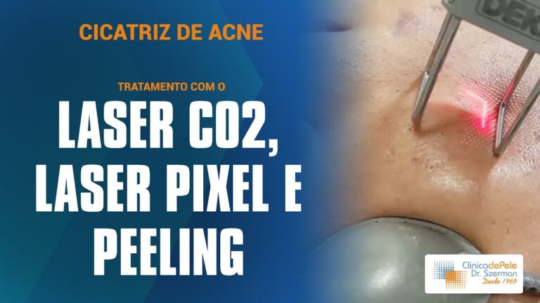 Tratamento a Laser para Marcas de Acne: Efic&aacute;cia e Benef&iacute;cios