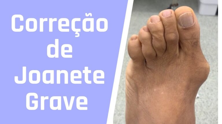 Pre&ccedil;os da cirurgia de joanetes: o que esperar