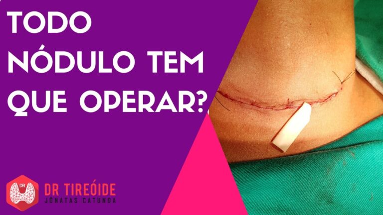 Quando operar n&oacute;dulos na tireoide: uma an&aacute;lise otimizada