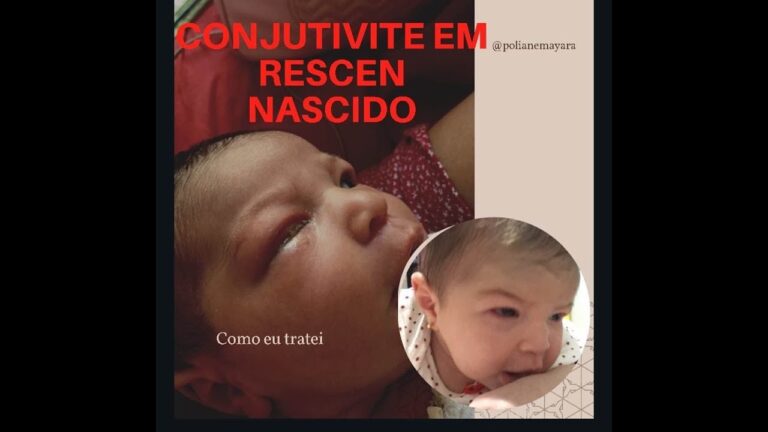 Conjuntivite em Beb&ecirc;s: Uso do Clorocil para Tratamento