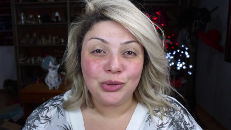 Transforma&ccedil;&atilde;o com Laser para Sardas: Antes e Depois