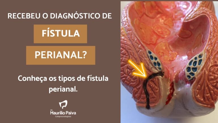 F&iacute;stula Perianal Transesfincteriana: Causas, Sintomas e Tratamentos