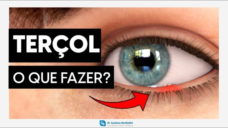 Como curar um terçolho: dicas eficazes