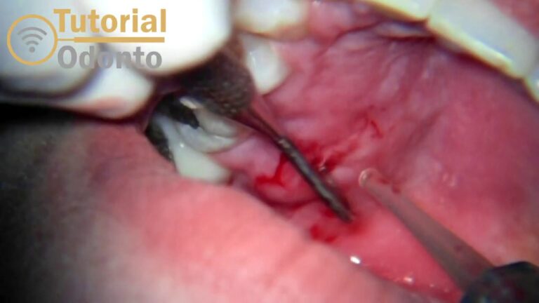 Drenagem de Abscesso Dent&aacute;rio: Guia Completo