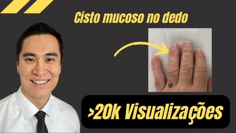 Tratamento eficaz para cisto no dedo da m&atilde;o