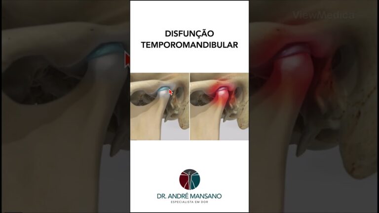 Solu&ccedil;&otilde;es eficazes para disfun&ccedil;&atilde;o temporomandibular