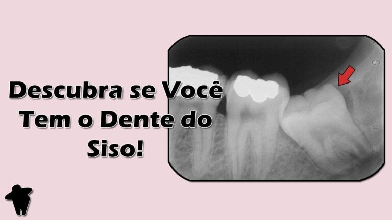 Idade ideal para extra&ccedil;&atilde;o do dente do siso