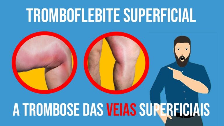 Tromboflebite Superficial: Fotos e Informa&ccedil;&otilde;es Essenciais