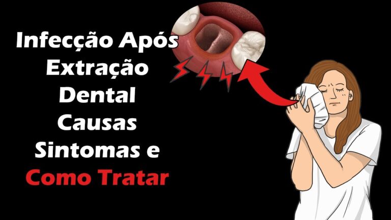Sintomas de infec&ccedil;&atilde;o ap&oacute;s extra&ccedil;&atilde;o do dente do siso