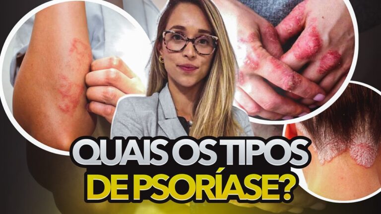Psor&iacute;ase no Couro Cabeludo: Fotos e Informa&ccedil;&otilde;es
