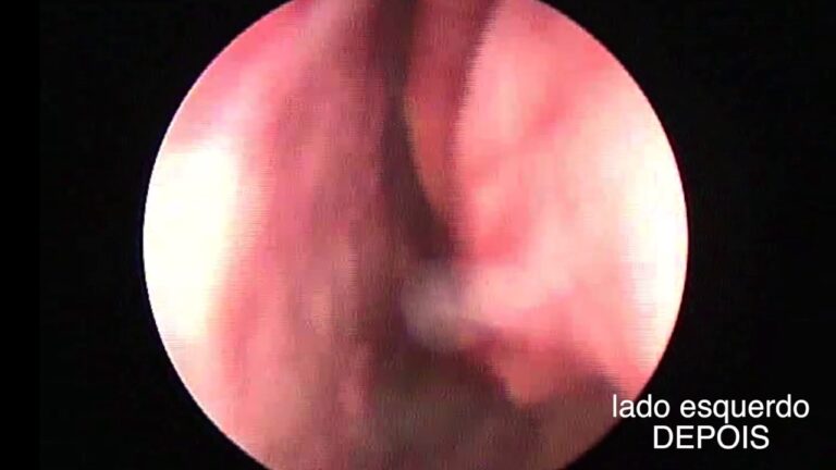 Septoplastia: Antes e Depois