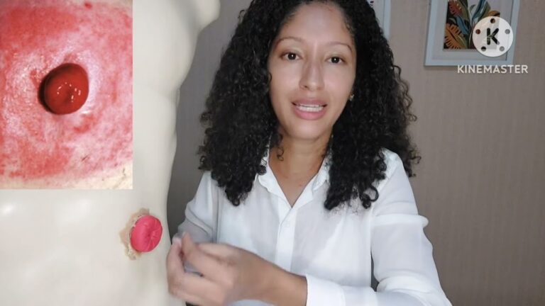 Ostomia Inflamada: Causas, Sintomas e Tratamento