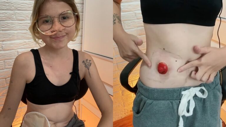 Guia Completo sobre Saco de Colostomia