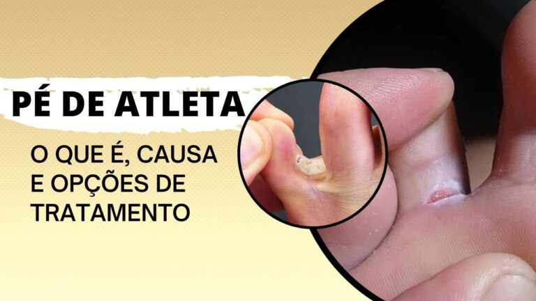 Creme para P&eacute; de Atleta: O Guia Completo
