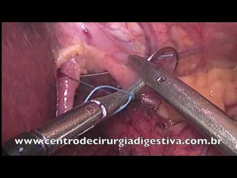 Benef&iacute;cios da Laparoscopia na Repara&ccedil;&atilde;o de Hernia de Hiato
