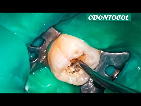 Carie Inicial: Como Identificar e Prevenir