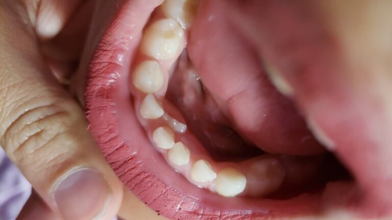 Alternativas ao Dente Definitivo a Abanar: Guia Completo
