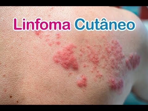 Diagn&oacute;stico do Linfoma Cut&acirc;neo: Fotos e Informa&ccedil;&otilde;es Importantes
