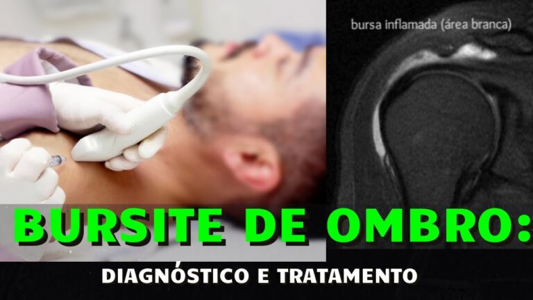 Tratamento eficaz da bursite no ombro