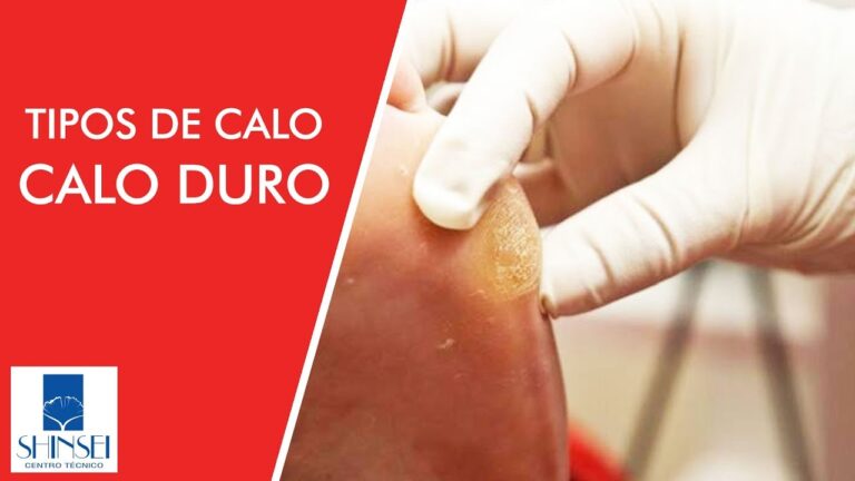 Guia completo dos tipos de calos nos p&eacute;s