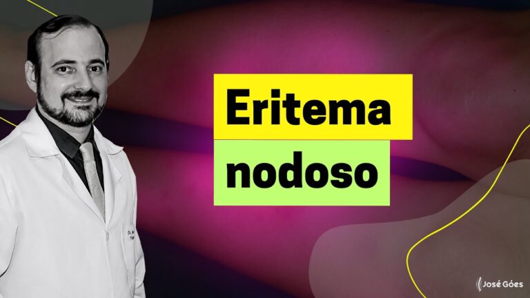 O perigo do eritema nodoso: entenda a gravidade da condição