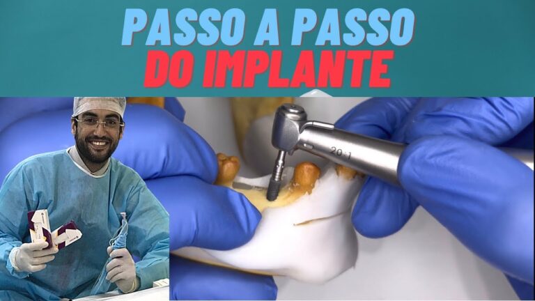 Implante Dent&aacute;rio: O Que Voc&ecirc; Precisa Saber
