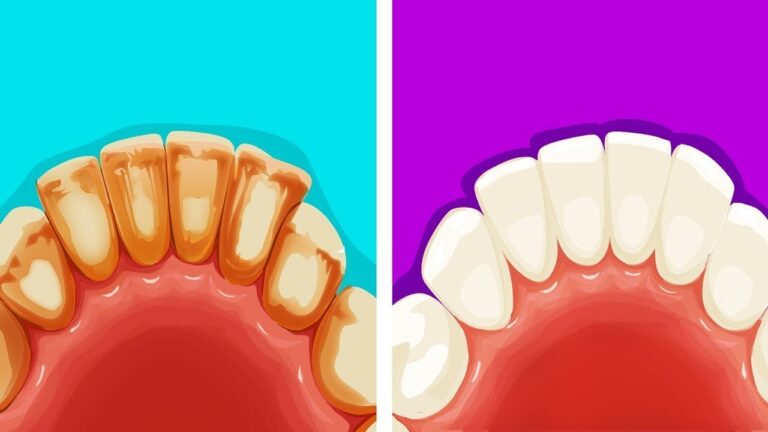Remova sua placa dent&aacute;ria em casa: dicas e truques