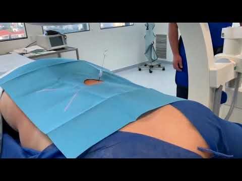 Ozonioterapia para Hernia Discal: Pre&ccedil;o e Benef&iacute;cios