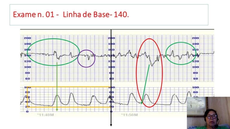 Entendendo o Cardiotoco e Suas Implicações nas Contrações
