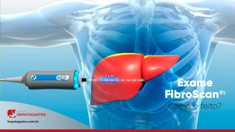 Guia Completo sobre o Preço do Fibroscan