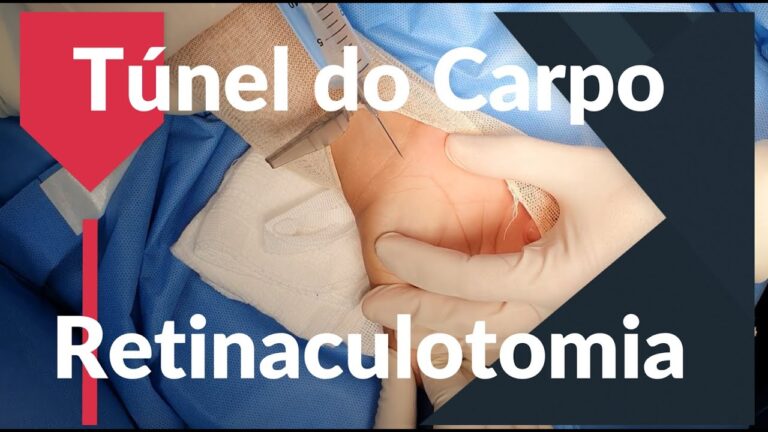 Cirurgia de T&uacute;nel do Carpo: Solu&ccedil;&otilde;es e Benef&iacute;cios