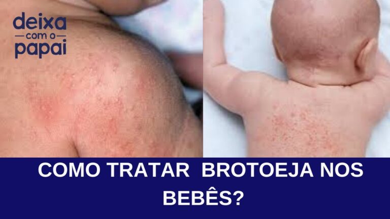 Guia Completo sobre Borbulhas no Beb&ecirc;