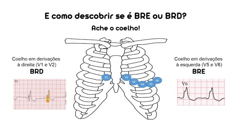 Diagn&oacute;stico de Bloqueio de Ramo Direito por ECG