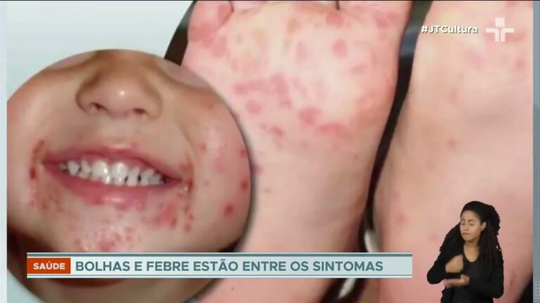 Como Tratar Borbulhas &agrave; Volta da Boca do Beb&ecirc;