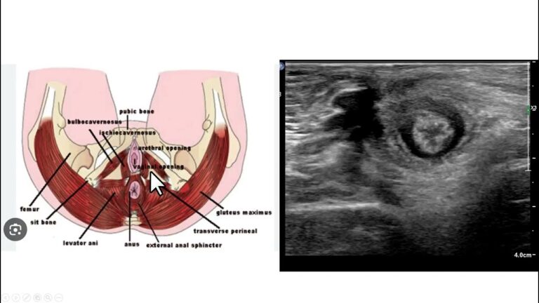 Fotos de Cicatriz de Episiotomia: O Que Esperar