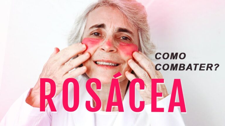 Benef&iacute;cios do &Oacute;leo de Coco para a Ros&aacute;cea