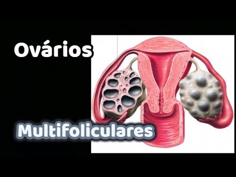 Tratamento eficaz para ov&aacute;rios multifoliculares