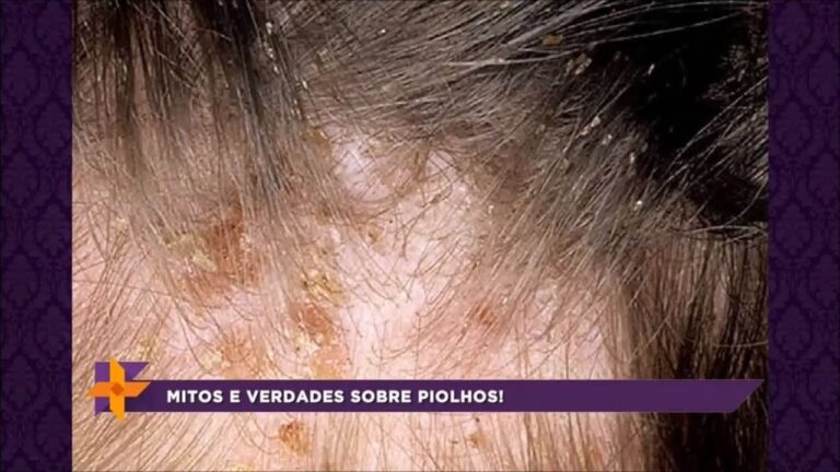 Piolhos Saltam: Mitos e Verdades
