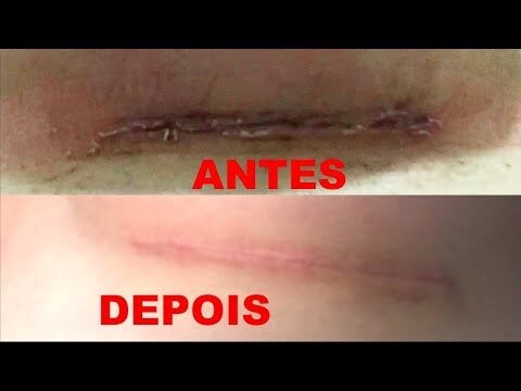 Dermatix ou Kelo Cote: Qual o Melhor Tratamento para Cicatrizes?