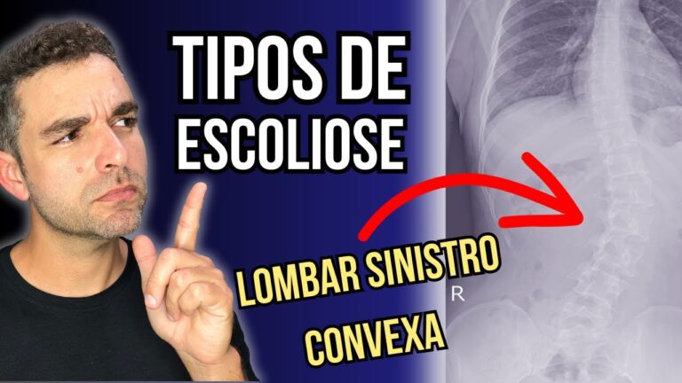 Entendendo a Escoliose Sinistro Convexa: Causas e Tratamentos