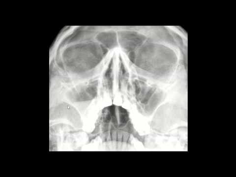 Espessamento da Mucosa Nasal: Causas e Tratamento