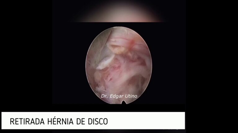 Opera&ccedil;&atilde;o para H&eacute;rnia Discal L5-S1: O que Saber