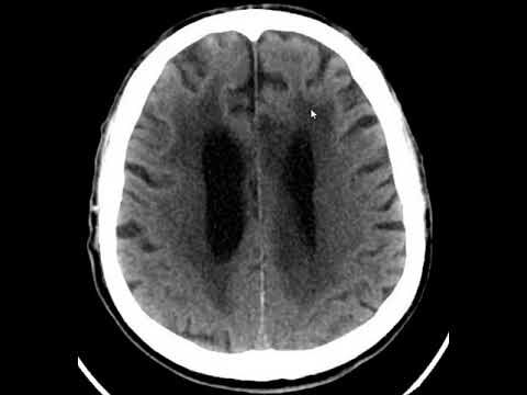 Entendendo a Hipodensidade da Substância Branca Subcortical