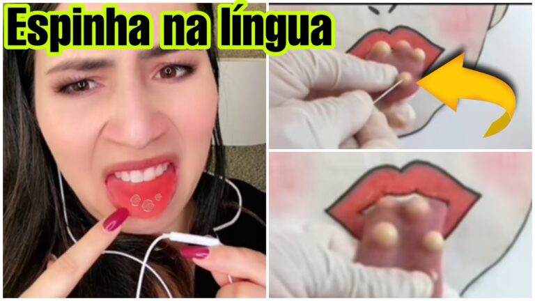 Espinha na L&iacute;ngua: Causas e Tratamentos Eficazes